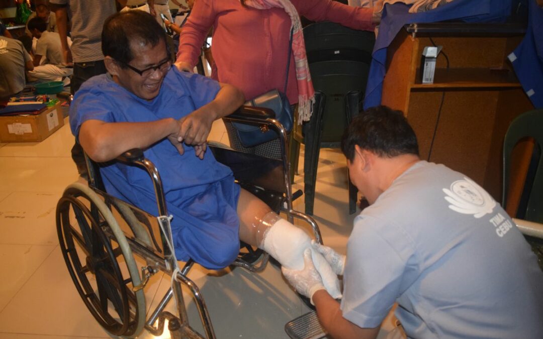 Prosthesis Casting Brings Hope To The Bohol Amputees